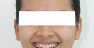 Ưu điểm Chỉnh răng không nhổ răng