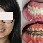 Chỉnh hình răng thẩm mỹ điều trị không nhổ răng