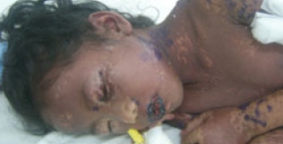 Cứu sống một trường hợp trẻ bị hội chứng Stevens Johnson nặng 