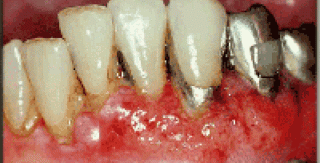 Các khối u ác tính vùng hàm mặt (Malignant tumor, oral cancer) 