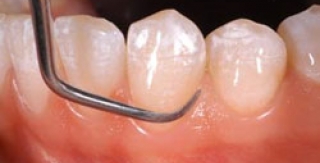 Các cách chữa trị răng sâu