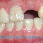 Implant môt răng trước
