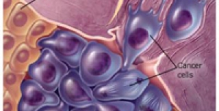Khối u vùng hàm mặt (Oral tumors) 