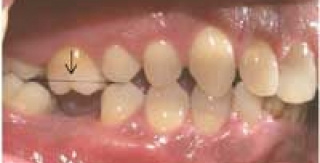 Chuyện gì xảy ra sau khi nhổ răng?