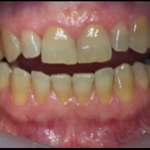 Răng nhiễm Tetracycline - Nguyên nhân và cách khắc phục 
