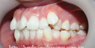 Chỉnh hình răng thẩm mỹ điều trị răng chen chúc với mắc cài kim loại 1