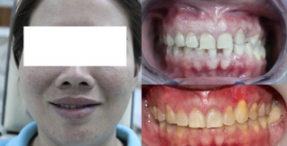 Răng nhiễm tertracycline - răng nanh ngầm - răng thưa 