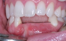 Mất răng nếu không được phục hồi ( làm răng giả ) sẽ đưa đến hậu quả gì ?
