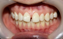 Niềng răng thưa thẩm mỹ