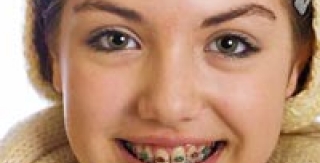 Niềng răng có nhổ răng