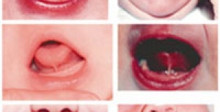 Dính thắng lưỡi ở trẻ em - Những điều cần biết - Phần 2