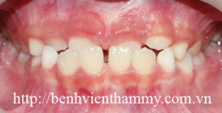 Chỉnh hình răng can thiệp sớm cắn ngược răng trước