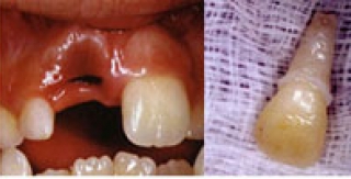 Những bước khẩn cấp để giữ lại răng bị rơi ra ngoài xương ổ