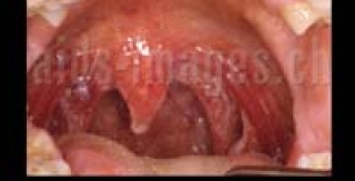 Một số biểu hiện nhiễm HIV ở họng 