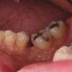Mất răng, tăng nguy cơ ung thư