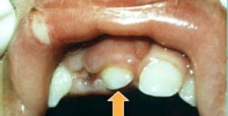 Xử trí chấn thương răng sữa 