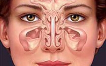 Viêm xoang hàm do răng (Sinusitis) 
