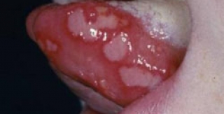 Loét miệng ở trẻ em 