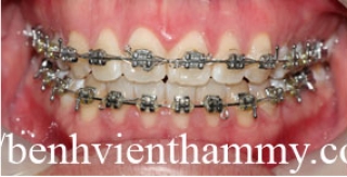 Chỉnh hình răng thẩm mỹ điều trị răng chen chúc với mắc cài kim loại 3