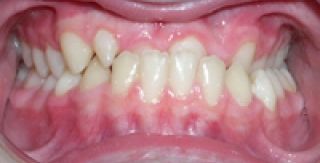 TIN VUI CHO NGƯỜI BỊ VẨU NẶNG XƯƠNG HÀM DƯỚI