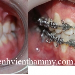 Chỉnh hình răng thẩm mỹ điều trị răng móm 1
