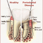 Bệnh nha chu (periodontal disease) 