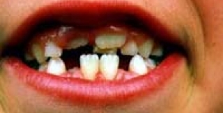 Khi trẻ mọc răng 