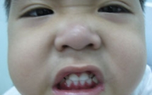 Viêm nướu răng ở trẻ em 