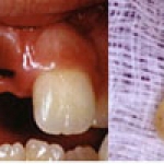 Những bước khẩn cấp để giữ lại răng bị rơi ra ngoài xương ổ