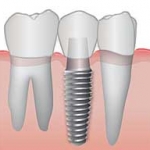 Cấy Ghép Implant Thay Thế Nhiều Răng 