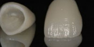 HỆ THỐNG SỨ E.MAX TẠI AVA