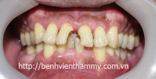 Trám răng Composite-Tetric-N-Ceram A3-C2-DentinA3,5-C1-Ivoclar