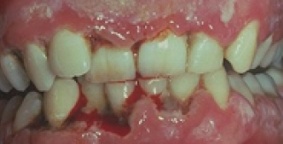 Một số bệnh nhiễm khuẩn ở vùng miệng và vòm hầu 
