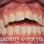 Chỉnh hình răng thẩm mỹ điều trị răng hô – cắn hở với mắc cài kim loại 2