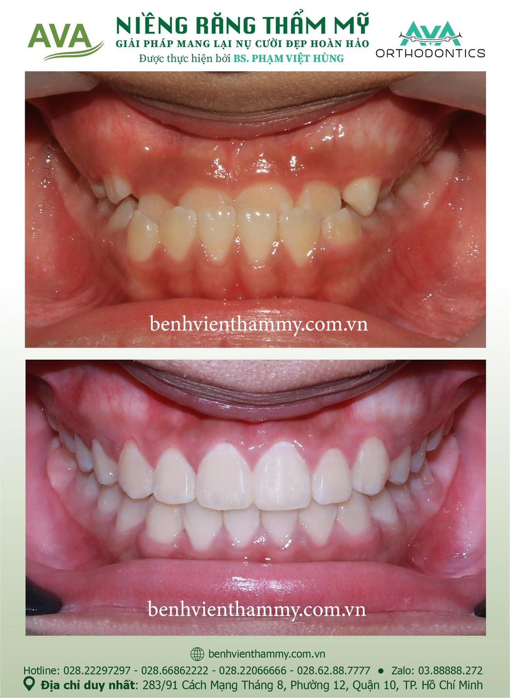 hinh anh nieng rang mom khop can nguoc 2