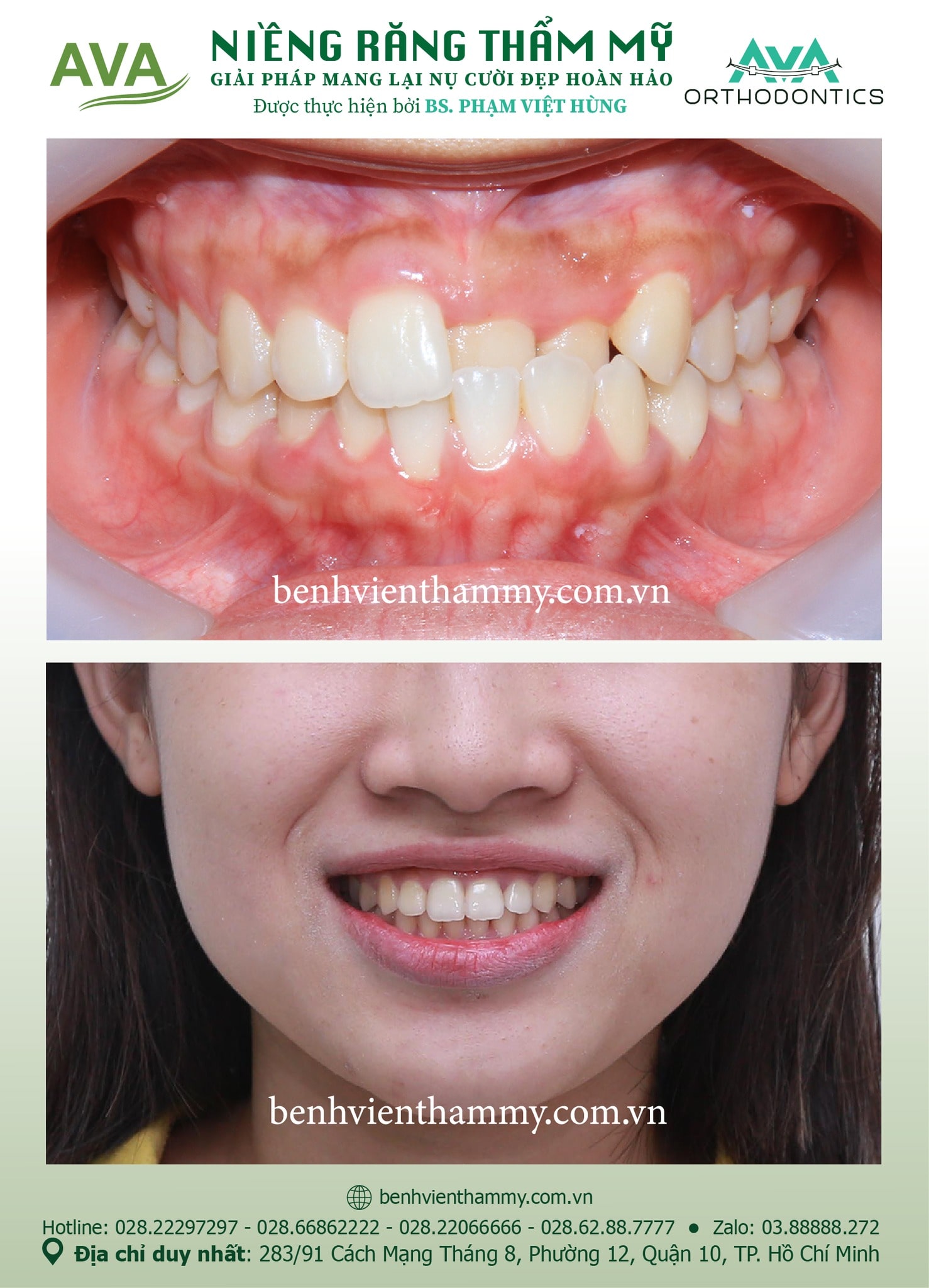 hinh anh nieng rang mom khop can nguoc 4