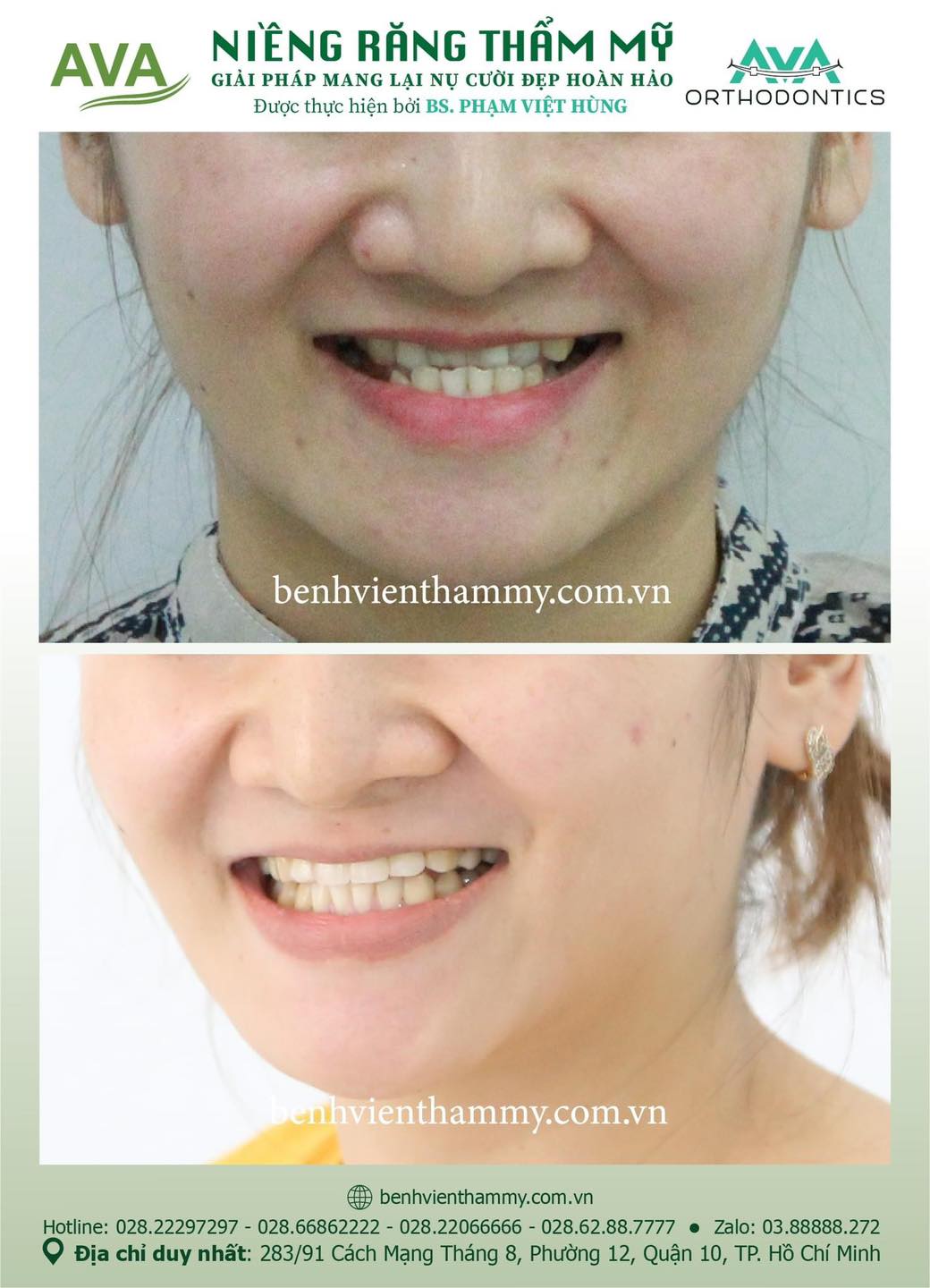 hinh anh nieng rang mom khop can nguoc 7