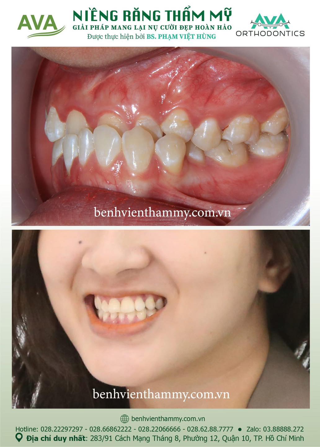 hinh anh nieng rang mom khop can nguoc 8