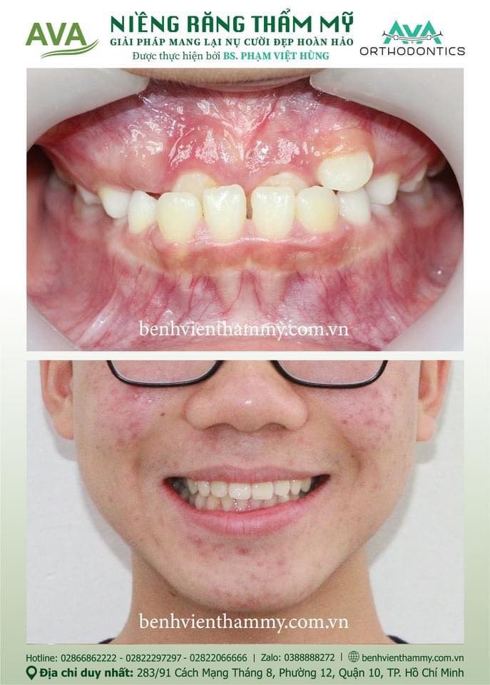 hinh anh nieng rang mom khop can nguoc 9