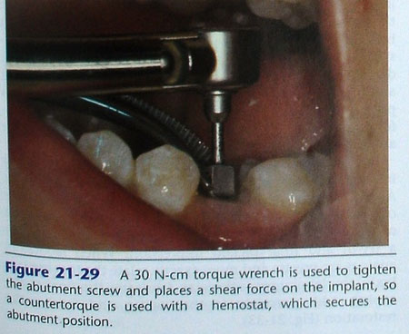 phuc-hinh-implant-3
